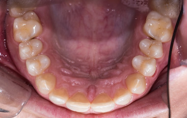 Healthy human teeth - incisors, frontal close up view