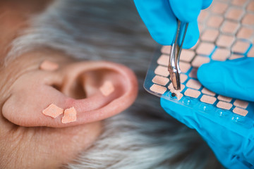Ear Acupuncture Point Therapy - obrazy, fototapety, plakaty