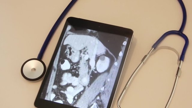 CT scan on a tablet for diagnosis .