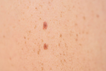 Fototapeta premium Close up detail of the bare skin on a man back with scattered moles and freckles. Checking benign moles. Sun effect on skin. Birthmarks on skin
