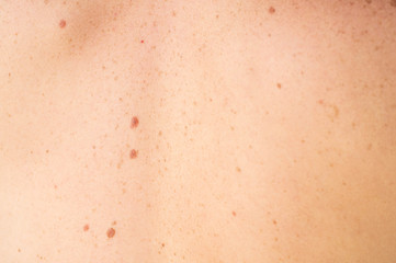 Fototapeta premium Close up detail of the bare skin on a man back with scattered moles and freckles. Checking benign moles. Sun effect on skin. Birthmarks on skin