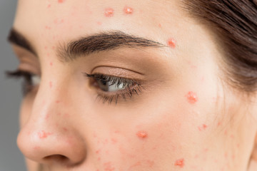 close up of woman with pimples on face isolated on grey