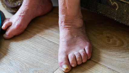 old feet, damaged toes and wrinkled legs with veins of old woman.