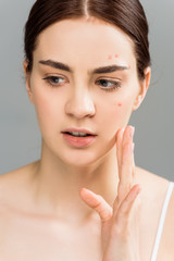 attractive young brunette woman with acne touching face isolated on grey