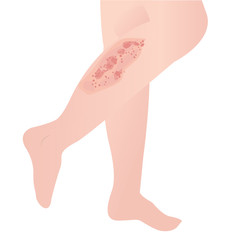 psoriasis skin disease