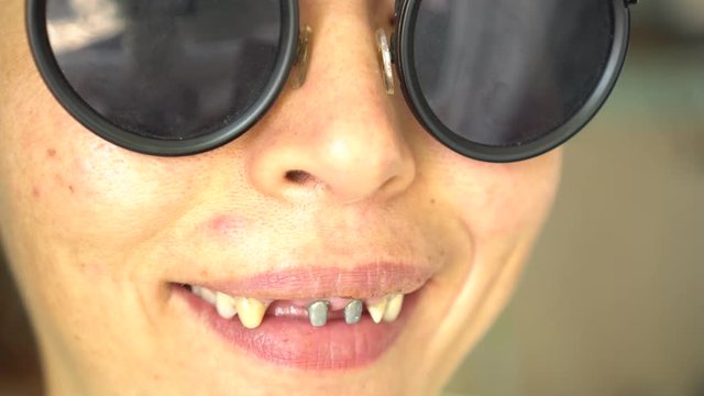 Ugly smile dental problem. Teeth Injuries or Teeth Falling in female. Post and core