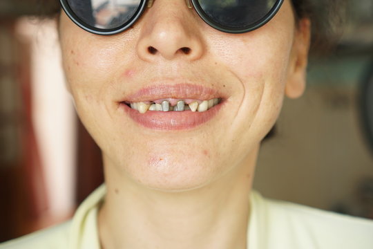 Ugly toothless young woman smiling