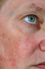 Woman face skin with vascular stars and couperose.