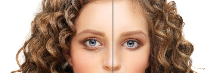 Lower eyelid blepharoplasty.Upper blepharoplasty.Before and after cosmetic procedures