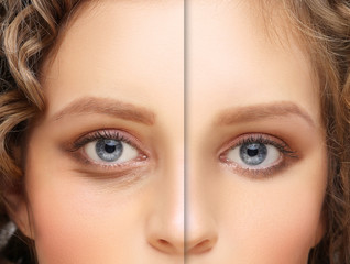 Lower eyelid blepharoplasty.Upper blepharoplasty.Before and after cosmetic procedures