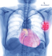 Chest X-ray or X-Ray Image Of Human Chest with pacemaker placement or Cardiac Pacemakers for control heart in patient arrhythmia . check up concept.