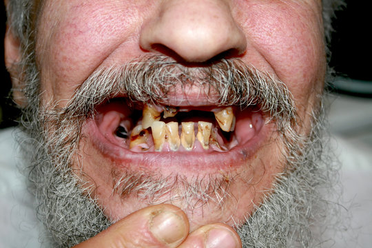 Teeth rotten woman with Rotten Teeth