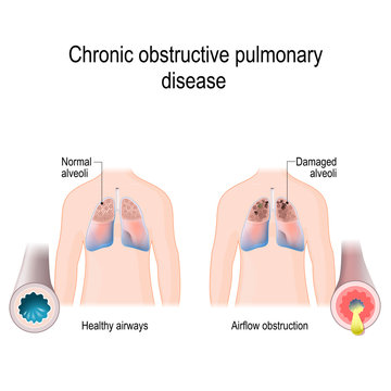 Chronic Obstructive Pulmonary Disease (COPD)