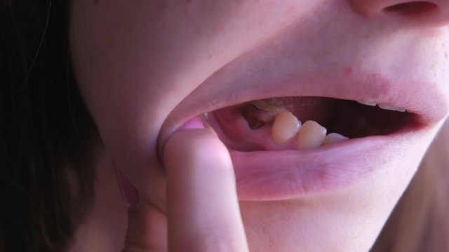 Young woman shows her pain tooth. Pink tooth with caries and cured with using resorcinol-formalin paste. Old method of treatment with toxic materials. Closeup view.