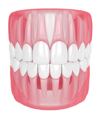 3d render of jaw with teeth over white