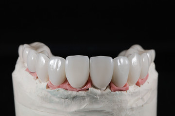 set of ceramic crowns for the upper jaw on the model, shot on a black background