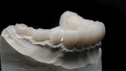 beautiful ceramic crowns for high-quality upper jaw on the model © Dental Pro Content
