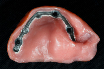 Dental prosthesis on the inside for attachment to the oral cavity