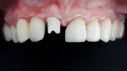 the base is the basis for the installation of dental crowns of the front tooth