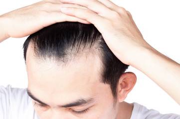 Fototapeta premium Young man serious hair loss problem for health care medical and shampoo product concept
