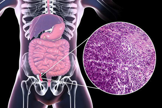 Acute appendicitis, 3D illustration of human body with inflammed appendix and light micrograph, photo under microscope
