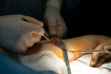 Metallic plate connecting bone during the surgery