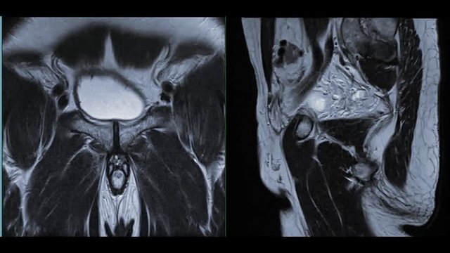 MRI Lower abdomen or MRI prostate gland for diagnosis prostate cancer.