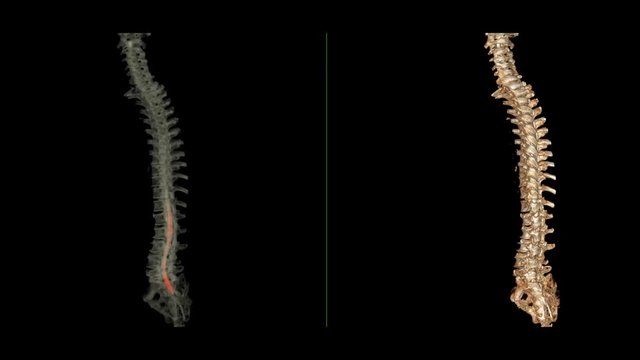 Comparison of CT myelography with whole spine 3D rendering image is particularly sensitive at detecting small disk herniations compressing nerves of the spine from CT scanner. 