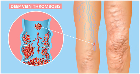 Deep Vein Thrombosis or Blood Clots. Embolus.