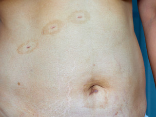 Scars on the skin from surgery