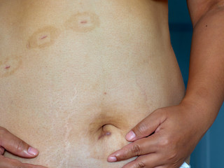 Fototapeta premium Scars on the skin from surgery