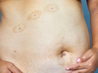 Fototapeta premium Scars on the skin from surgery
