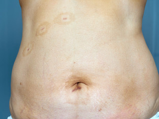 Fototapeta premium Scars on the skin from surgery