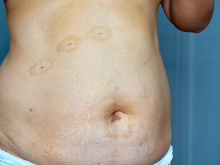 Naklejka premium Scars on the skin from surgery
