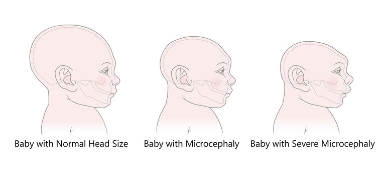 Comparative anatomical image of the head and skull of a newborn child with a normal cranium and with microcephaly and severe microcephaly. Virus of Zika. Vector. Isolated on white background