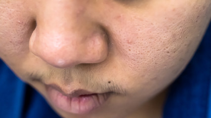 Naklejka premium Facial acne is Asian women aged 25-30 and pores wrinkles are allergic to cosmetics.