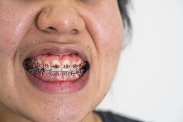 Asian women's teeth aged 25-30 years, not scale. Yellow teeth,Women wearing braces.
