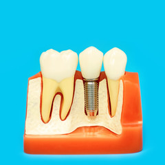 medical model of the jaw with false teeth on a pin on blue background