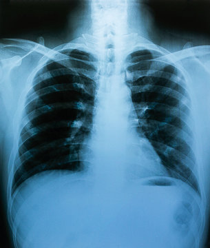 X-ray film, lung and bone structure, health examination