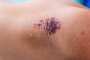 Schürfwunde am Knie eines Kindes mit roter Kruste aus Blut nach einem Ausrutscher beim Spielen und...