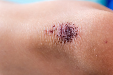 Schürfwunde am Knie eines Kindes mit roter Kruste aus Blut nach einem Ausrutscher beim Spielen und...