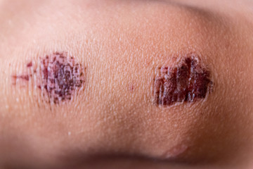 Schürfwunde am Knie eines Kindes mit roter Kruste aus Blut nach einem Ausrutscher beim Spielen und...