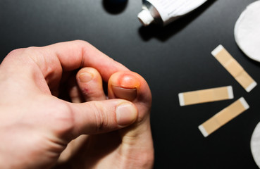 Callus blisters on feet. Man is applying cream on painful wounds. Antiseptic band-aid plasters. Uncomfortable shoes problems. Footballer's legs.