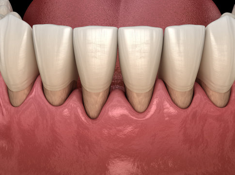 Gum recession process. Medically accurate 3D illustration