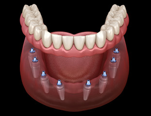 Mandibular prosthesis All on 8 system supported by implants. Medically accurate 3D illustration of human teeth and dentures concept