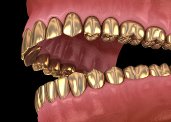 Golden teeth crowns over natural teeth. Medically accurate 3D illustration of human teeth treatment