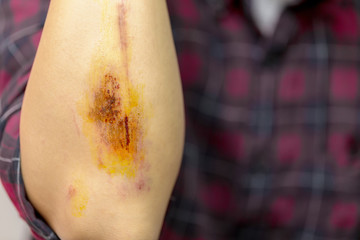 Young Man With Bloody Scrape on Arm