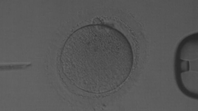 Fertilization in vitro, needle puncture of human egg and sperm injection.  IVF, needle, sperm.
