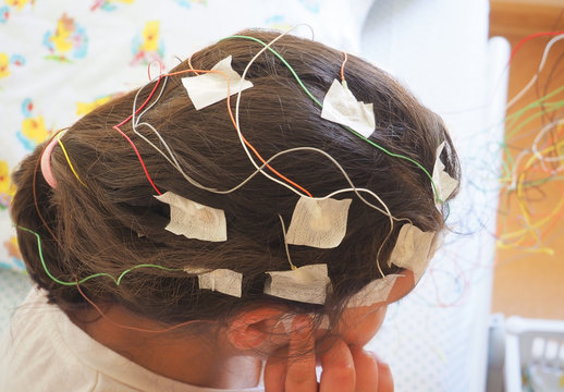 Girl with EEG electrodes attached to her head for medical test