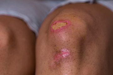 Women injury - painful knee wound accident - Bruised wound injury on woman knee - Medical and health conditions